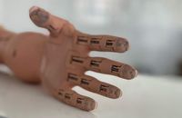 У Львові чоловіку встановили протез руки, надрукований на 3D-принтері